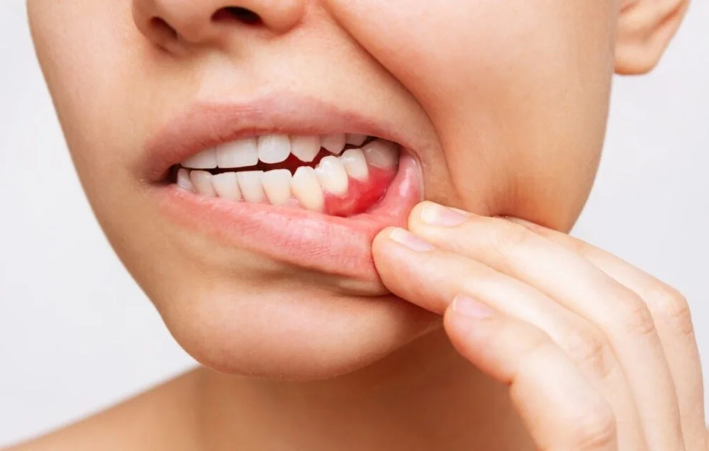 Understanding the Basics of a Tooth Infection